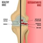Knee Pain