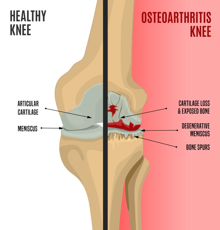 Knee Pain in Collingwood, Ontario