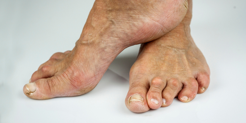 Arthritic Feet in Aurora, Ontario