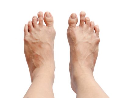 Foot Orthotics in King City, Ontario